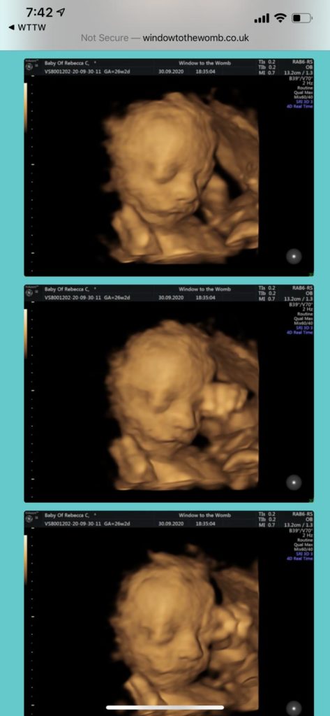 3D scan of Winnie in the womb. Infertility is defeated!
